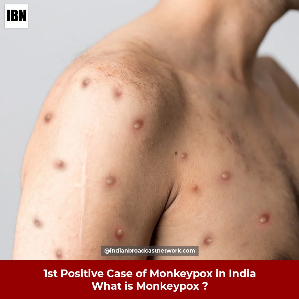 First Positive Case of Monkey Pox in India - Indian Broadcast Network